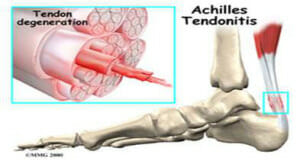 Achilles Tendonitis