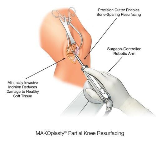Mako surgery
