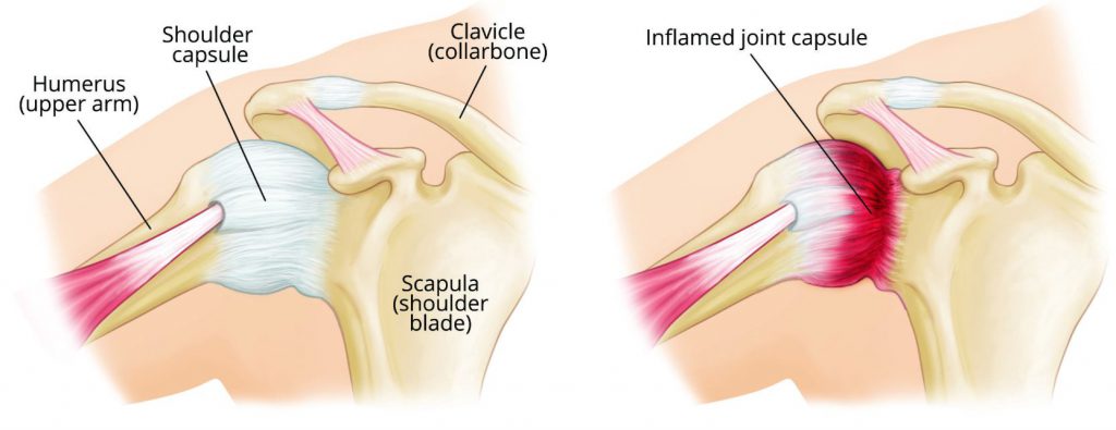 Frozen Shoulder